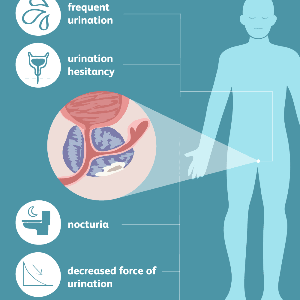 symptoms of prostate cancer